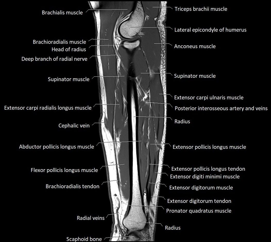 MRI 3T forearm sagittal labelled cross sectional anatomy image 16.webp
